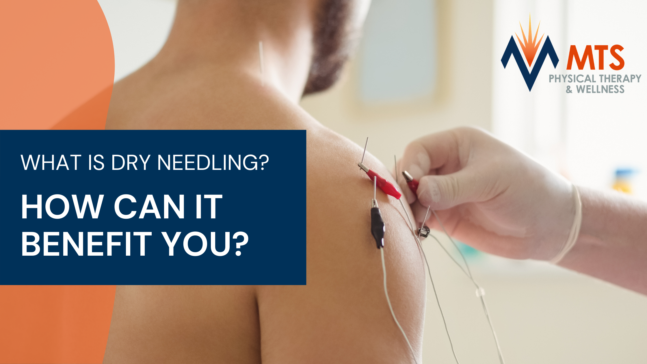 What Is Dry Needling And How Can It Benefit You